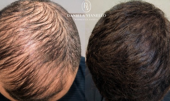 Antes e depois de regeneração capilar