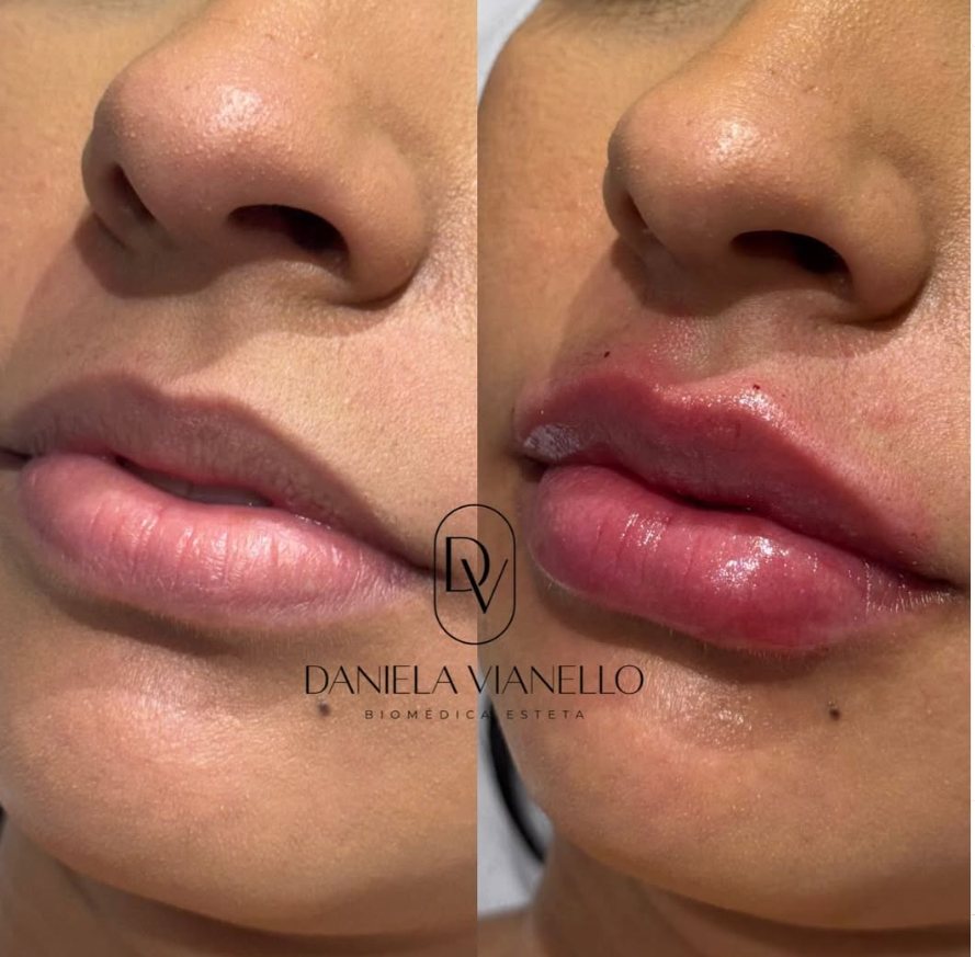 Antes e depois de preenchimento labial
