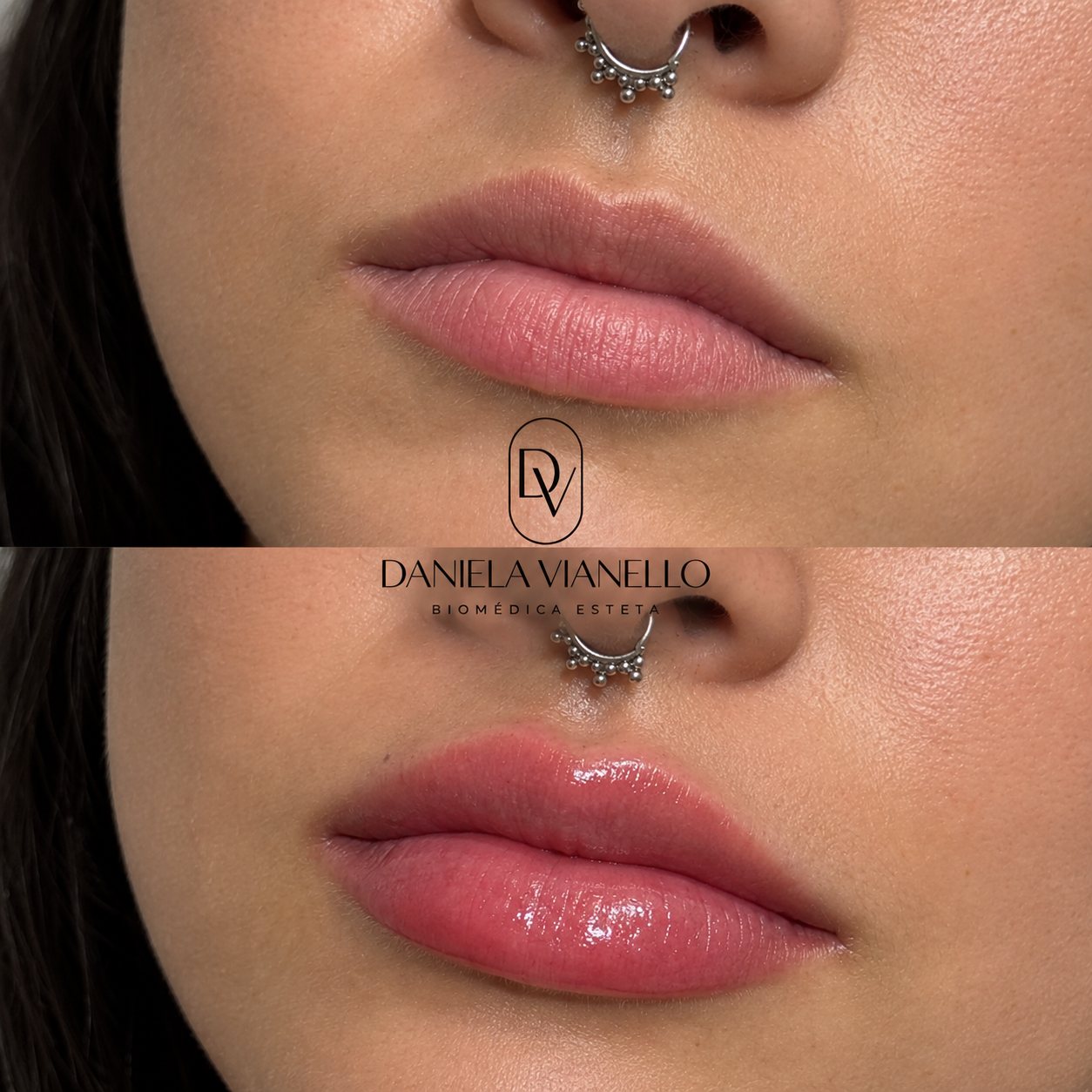 Antes e depois de preenchimento labial