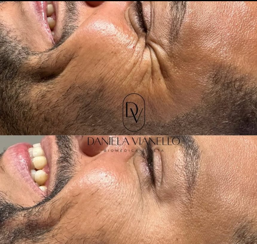 Antes e depois de toxina botulínica